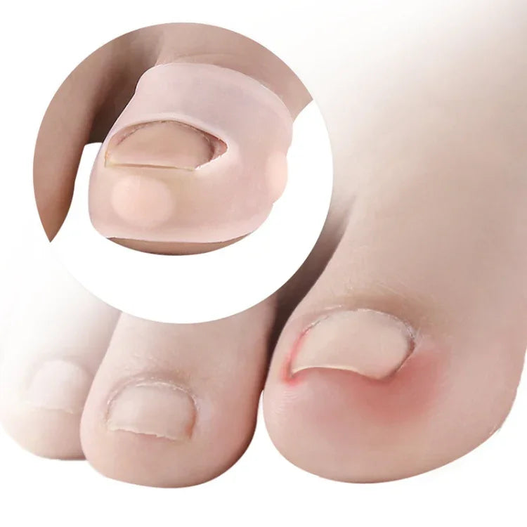 Ingrown Nails Prevent Nails From Growing Flesh Nail Corrections, Free Size